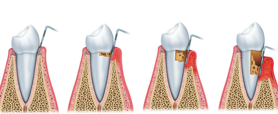 periodontitis periodoncia e implantes dentales odonticentrum moncloa madrid